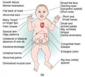 down syndrome sign